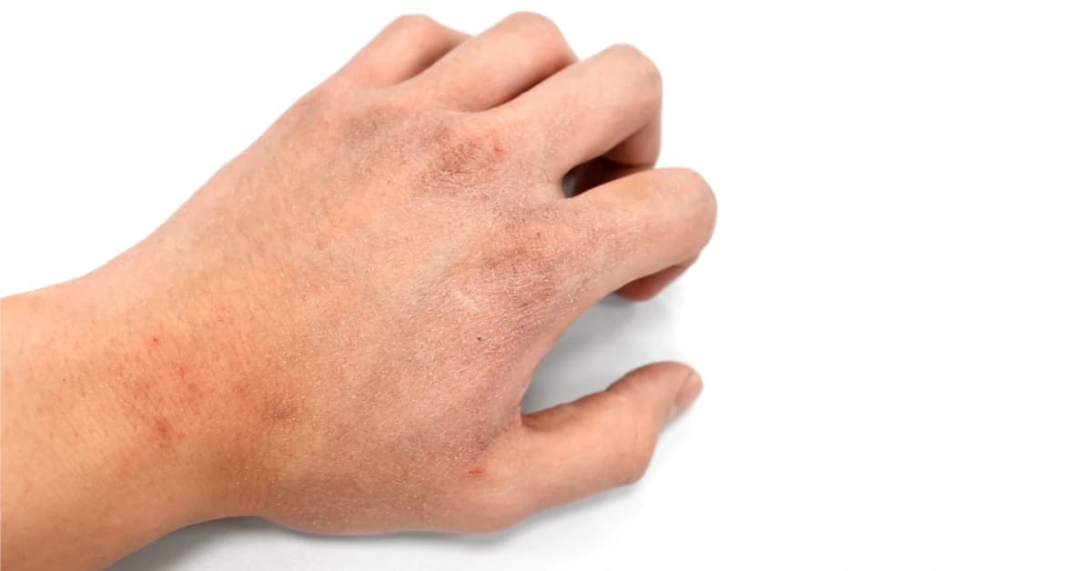 Dry hands