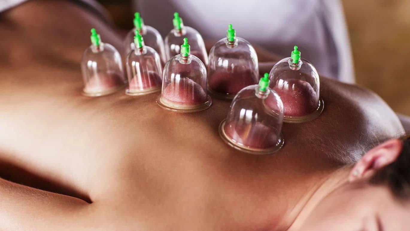 Cupping