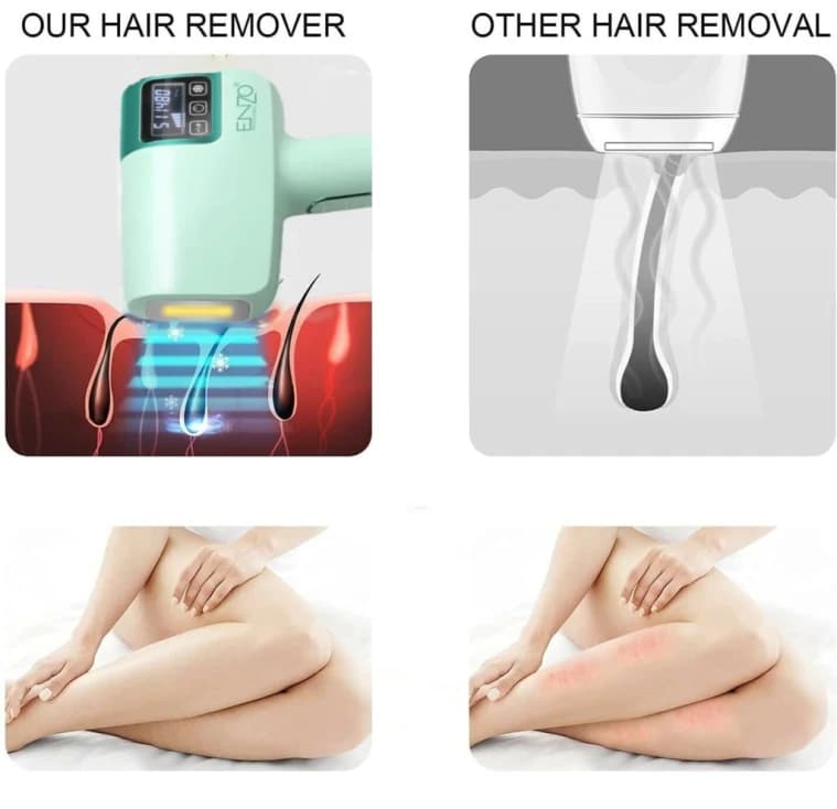 Enzo Icy Cool At-Home Laser Hair Removal Device