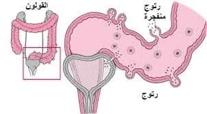 Diverticulosis