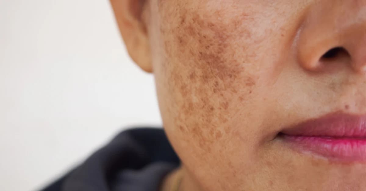 Remove brown spots from the face
