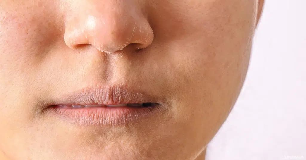 Causes of dry skin in winter