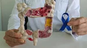 Appendiceal cancer