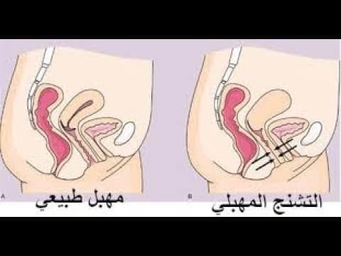 Causes of vaginismus