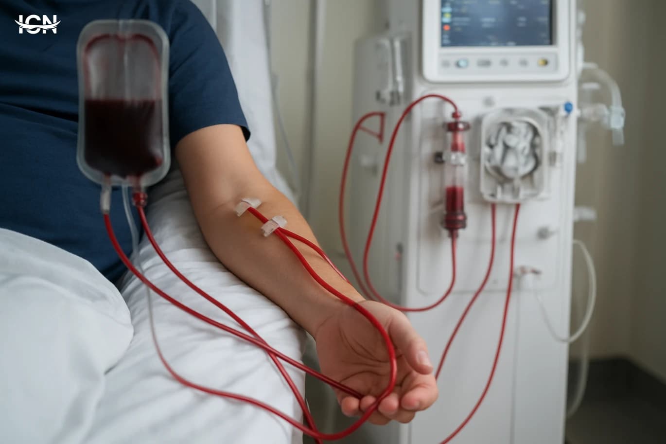 Blood Type and Dialysis Survival