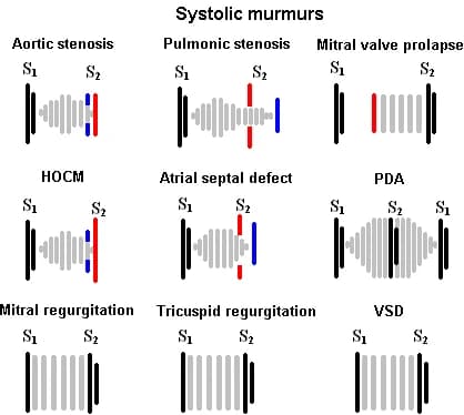Systolic Heart Murmur