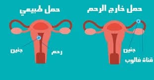 How does an ectopic pregnancy occur